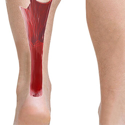 Achilles Tendonitis